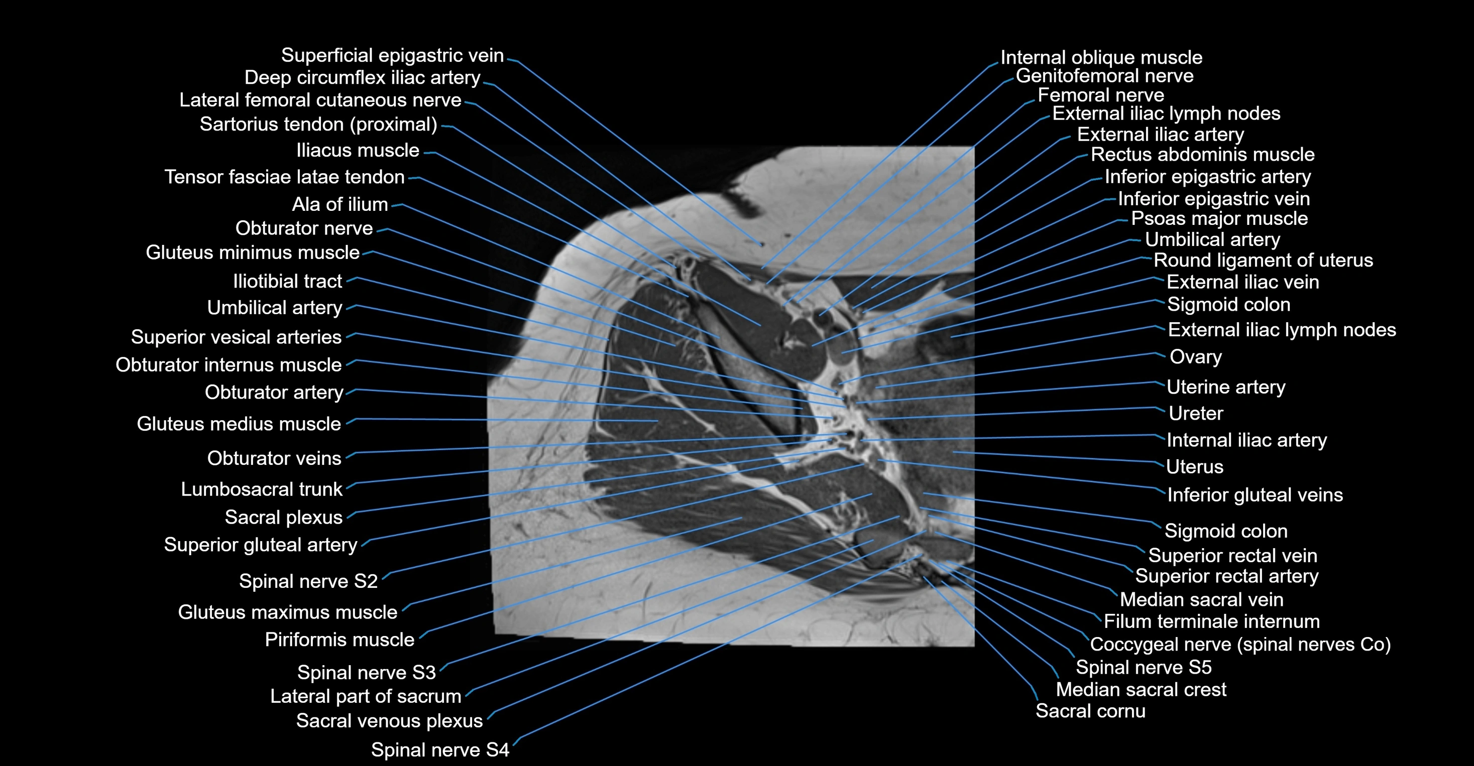 MRI hip axial cross sectional anatomy 3T 3D  radiology  anatomy image-img-00001-00013.webp